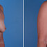 Breast reconstruction surgery before and after photos, right 45-degree angle view