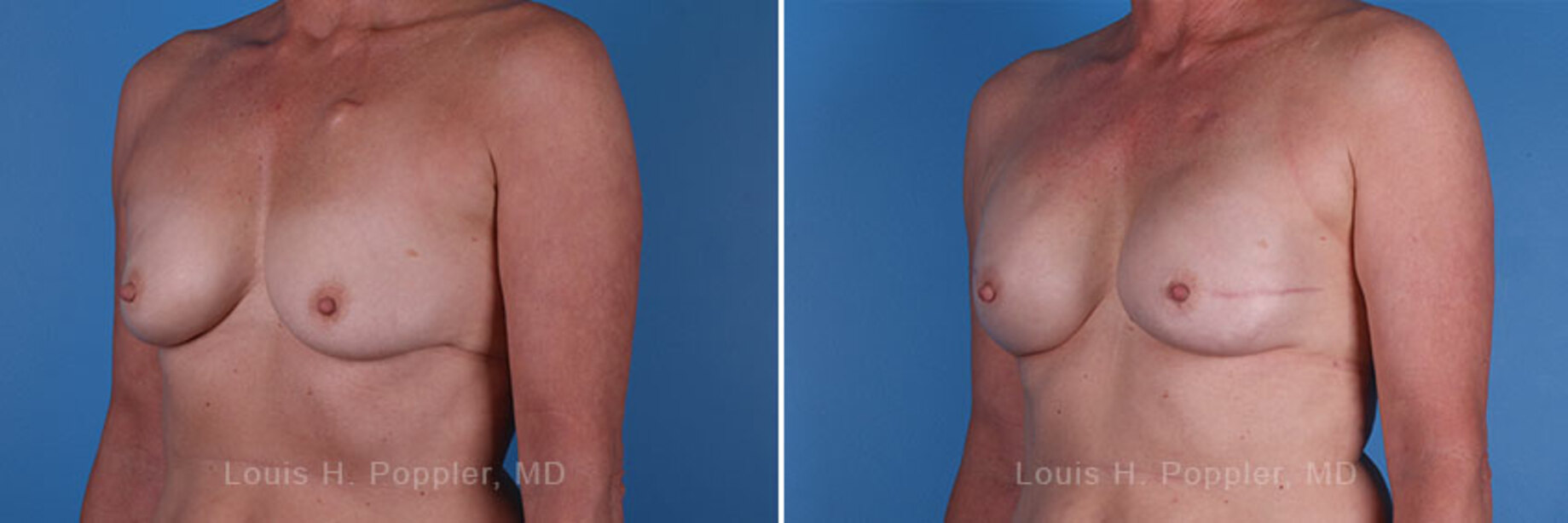 Breast reconstruction surgery before and after photos, left 45-degree angle view