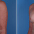 Breast reconstruction surgery before and after photos, left 45-degree angle view