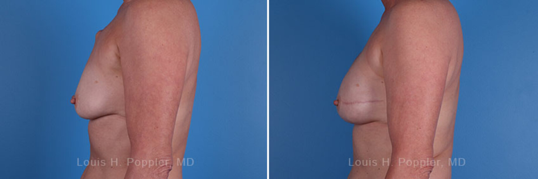 Breast reconstruction surgery before and after photos, left 90-degree angle view