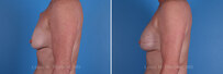Breast reconstruction surgery before and after photos, left 90-degree angle view
