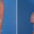 Breast reconstruction surgery before and after photos, left 90-degree angle view