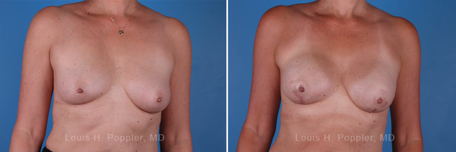 Breast reconstruction surgery before and after photos