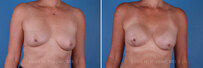 Breast reconstruction surgery before and after photos