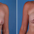 Breast reconstruction surgery before and after photos
