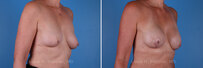 Breast reconstruction surgery before and after photos, right 45-degree angle view