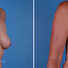 Breast reconstruction surgery before and after photos, right 45-degree angle view