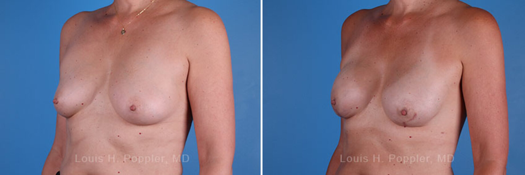 Breast reconstruction surgery before and after photos, left 45-degree angle view