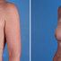 Breast reconstruction surgery before and after photos, left 45-degree angle view