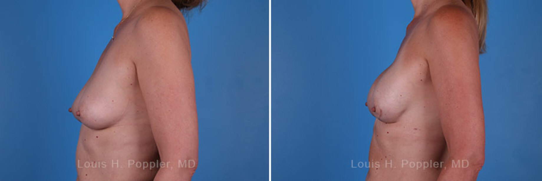 Breast reconstruction surgery before and after photos, left 90-degree angle view